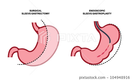 Gastrectomy and gastroplasty 104948916