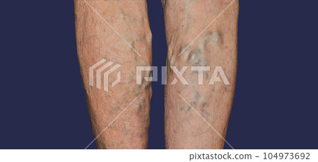 Varicose veins on a female legs. Phlebology and DVT. The old age and sick of a woman. Varicose veins on a legs of old woman on blue. 104973692