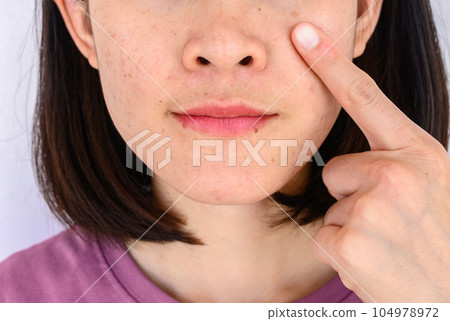 Close-up of woman pointing a problem on her face with variety problems on her skin (such as Acne, Pimple, Pores and Melasma etc). Conceptual of natural problem on woman skin. Close-up of woman pointing a problem on her face with variety problems on her skin (such as Acne, Pimple, Pores and Melasma etc). Conceptual of natural problem on woman skin. 104978972