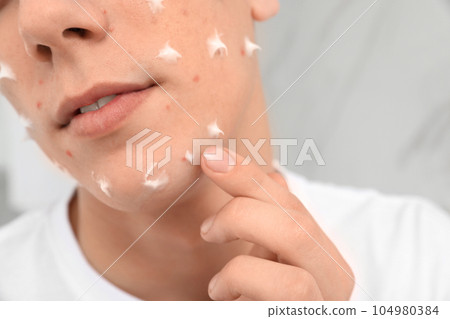 Teen guy with acne problem applying cream indoors, closeup 104980384