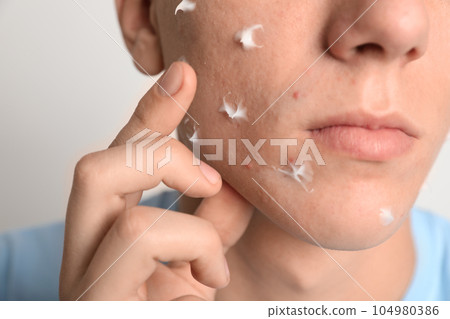 Teen guy with acne problem applying cream on light background, closeup 104980386