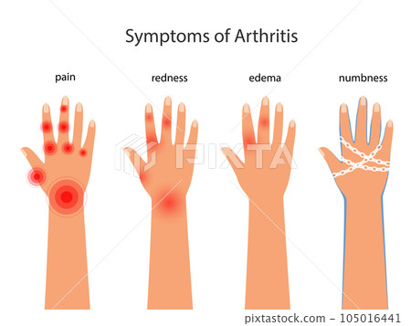 Symptoms of rheumatoid arthritis, redness, edema, numbness. Pain in the hands with autoimmune disease vector poster Symptoms of rheumatoid arthritis, redness, edema, numbness. Pain in the hands with autoimmune disease vector poster 105016441