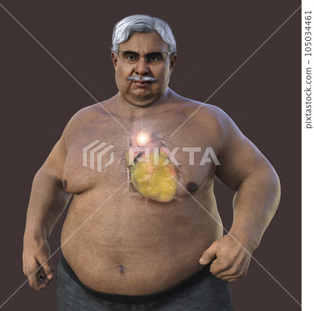 A 3D scientific illustration of a senior obese man with transparent skin revealing an ascending aortic aneurysm. A 3D scientific illustration of a senior obese man with transparent skin revealing an ascending aortic aneurysm. 105034461