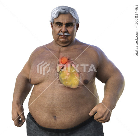 A 3D scientific illustration of a senior obese man with transparent skin revealing an ascending aortic aneurysm. A 3D scientific illustration of a senior obese man with transparent skin revealing an ascending aortic aneurysm. 105034462