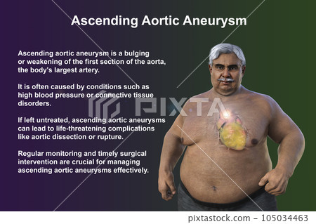A 3D scientific illustration of a senior obese man with transparent skin revealing an ascending aortic aneurysm. 105034463