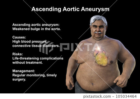 A 3D scientific illustration of a senior obese man with transparent skin revealing an ascending aortic aneurysm. 105034464