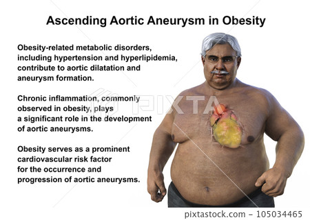 A 3D scientific illustration of a senior obese man with transparent skin revealing an ascending aortic aneurysm. A 3D scientific illustration of a senior obese man with transparent skin revealing an ascending aortic aneurysm. 105034465