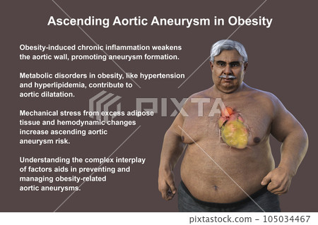 A 3D scientific illustration of a senior obese man with transparent skin revealing an ascending aortic aneurysm. A 3D scientific illustration of a senior obese man with transparent skin revealing an ascending aortic aneurysm. 105034467