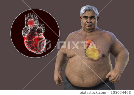 A 3D scientific illustration of a senior obese man with transparent skin revealing an ascending aortic aneurysm. A 3D scientific illustration of a senior obese man with transparent skin revealing an ascending aortic aneurysm. 105034468
