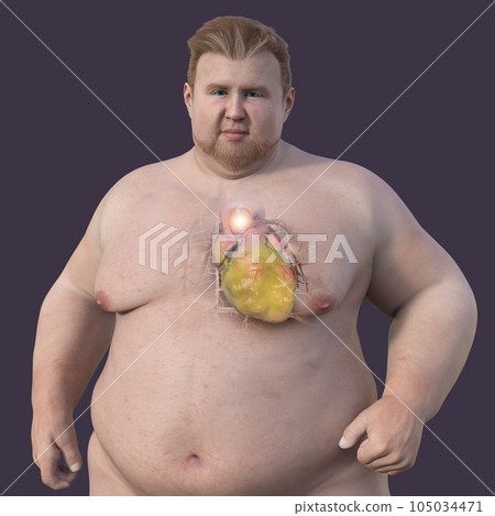 A 3D scientific illustration of an obese man with transparent skin revealing an ascending aortic aneurysm. A 3D scientific illustration of an obese man with transparent skin revealing an ascending aortic aneurysm. 105034471