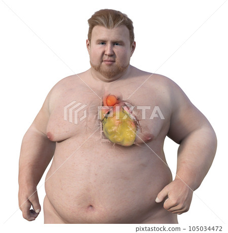 A 3D scientific illustration of an obese man with transparent skin revealing an ascending aortic aneurysm. A 3D scientific illustration of an obese man with transparent skin revealing an ascending aortic aneurysm. 105034472