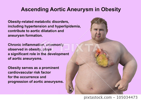 A 3D scientific illustration of an obese man with transparent skin revealing an ascending aortic aneurysm. A 3D scientific illustration of an obese man with transparent skin revealing an ascending aortic aneurysm. 105034473