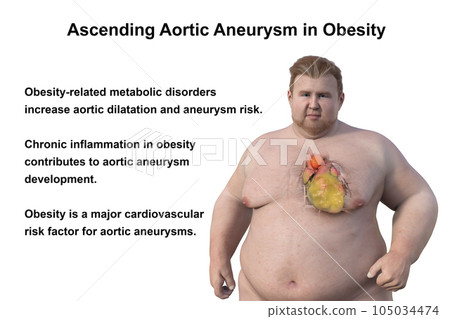 A 3D scientific illustration of an obese man with transparent skin revealing an ascending aortic aneurysm. A 3D scientific illustration of an obese man with transparent skin revealing an ascending aortic aneurysm. 105034474