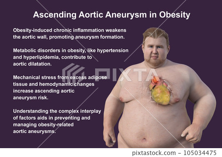 A 3D scientific illustration of an obese man with transparent skin revealing an ascending aortic aneurysm. A 3D scientific illustration of an obese man with transparent skin revealing an ascending aortic aneurysm. 105034475