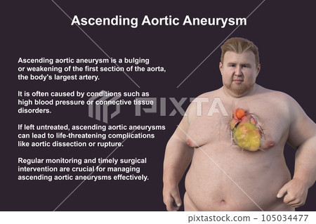 A 3D scientific illustration of an obese man with transparent skin revealing an ascending aortic aneurysm. A 3D scientific illustration of an obese man with transparent skin revealing an ascending aortic aneurysm. 105034477