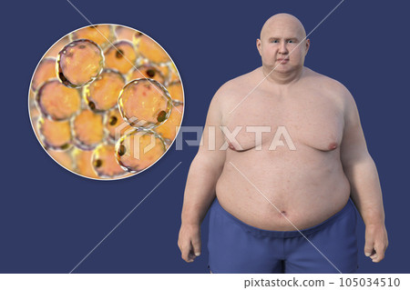 An overweight man with a close-up view of adipocytes, 3D illustration highlighting the role of these fat cells in obesity 105034510