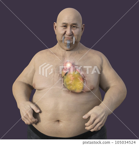 A 3D scientific illustration of an obese man with transparent skin revealing an ascending aortic aneurysm. A 3D scientific illustration of an obese man with transparent skin revealing an ascending aortic aneurysm. 105034524