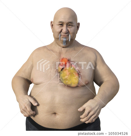 A 3D scientific illustration of an obese man with transparent skin revealing an ascending aortic aneurysm. A 3D scientific illustration of an obese man with transparent skin revealing an ascending aortic aneurysm. 105034526