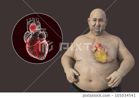 A 3D scientific illustration of an obese man with transparent skin revealing an ascending aortic aneurysm. A 3D scientific illustration of an obese man with transparent skin revealing an ascending aortic aneurysm. 105034541