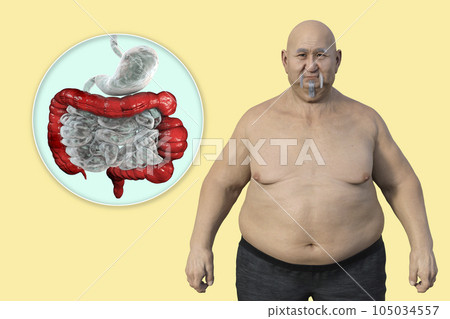 An overweight man with the presence of large intestine spasms associated with irritable bowel syndrome, 3D illustration 105034557