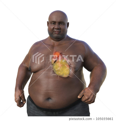 A 3D scientific illustration of an obese man with transparent skin revealing an ascending aortic aneurysm. A 3D scientific illustration of an obese man with transparent skin revealing an ascending aortic aneurysm. 105035661