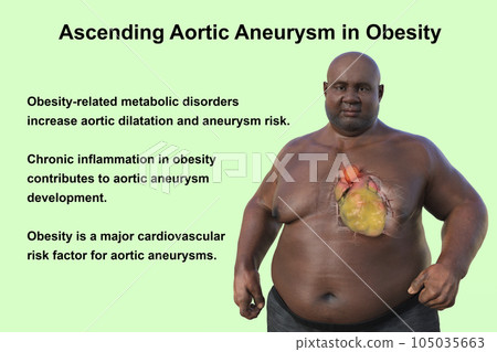 A 3D scientific illustration of an obese man with transparent skin revealing an ascending aortic aneurysm. 105035663