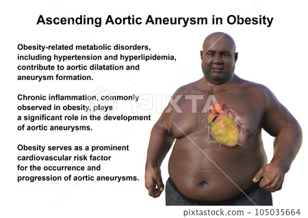 A 3D scientific illustration of an obese man with transparent skin revealing an ascending aortic aneurysm. A 3D scientific illustration of an obese man with transparent skin revealing an ascending aortic aneurysm. 105035664