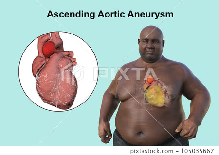 A 3D scientific illustration of an obese man with transparent skin revealing an ascending aortic aneurysm. 105035667
