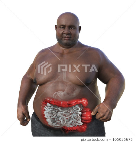 An overweight man with the presence of large intestine spasms associated with irritable bowel syndrome, 3D illustration An overweight man with the presence of large intestine spasms associated with irritable bowel syndrome, 3D illustration 105035675