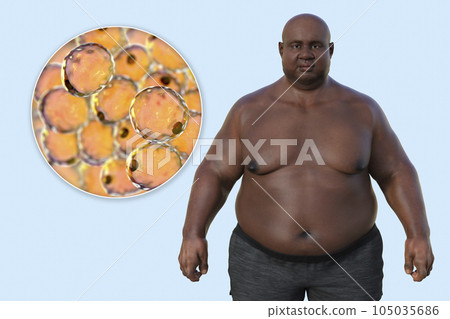 An overweight man with a close-up view of adipocytes, 3D illustration highlighting the role of these fat cells in obesity An overweight man with a close-up view of adipocytes, 3D illustration highlighting the role of these fat cells in obesity 105035686