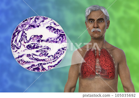 A 3D illustration of the upper half part of a man with transparent skin, revealing the condition of smoker's lungs A 3D illustration of the upper half part of a man with transparent skin, revealing the condition of smoker's lungs 105035692