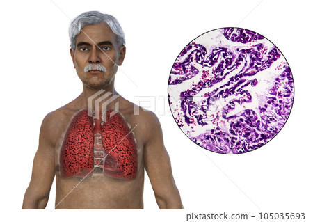 A 3D illustration of the upper half part of a man with transparent skin, revealing the condition of smoker's lungs A 3D illustration of the upper half part of a man with transparent skin, revealing the condition of smoker's lungs 105035693