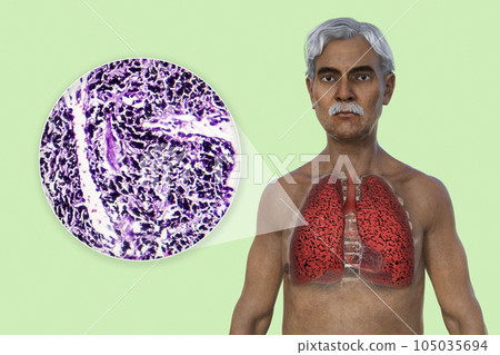 A 3D illustration of the upper half part of a man with transparent skin, revealing the condition of smoker's lungs A 3D illustration of the upper half part of a man with transparent skin, revealing the condition of smoker's lungs 105035694