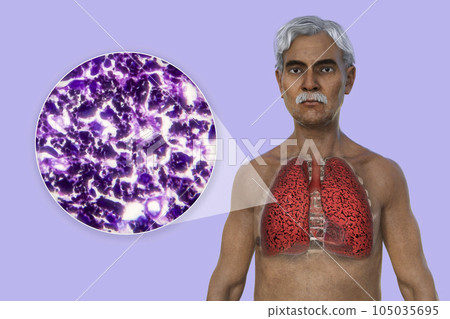 A 3D illustration of the upper half part of a man with transparent skin, revealing the condition of smoker's lungs 105035695