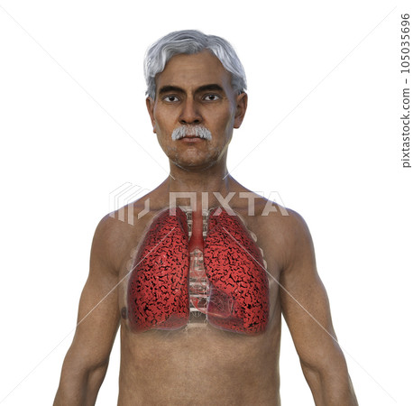 A 3D illustration of the upper half part of a man with transparent skin, revealing the condition of smoker's lungs 105035696