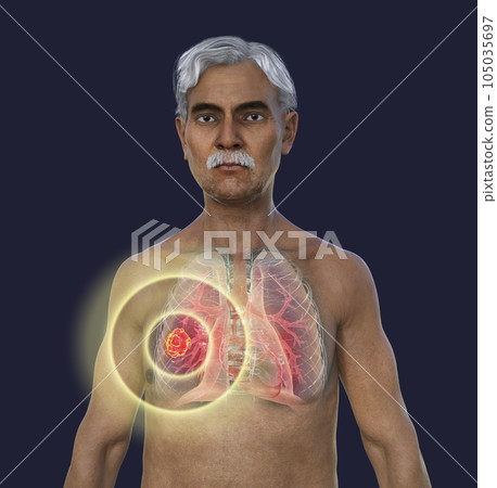 A 3D illustration of the upper half part of a man with transparent skin, revealing a lung mucormycosis lesion 105035697