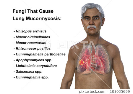 A 3D illustration of the upper half part of a man with transparent skin, revealing a lung mucormycosis lesion 105035699
