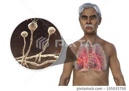 A 3D illustration of the upper half part of a man with transparent skin, revealing a lung mucormycosis lesion, with close-up view of Rhizopus fungi A 3D illustration of the upper half part of a man with transparent skin, revealing a lung mucormycosis lesion, with close-up view of Rhizopus fungi 105035700