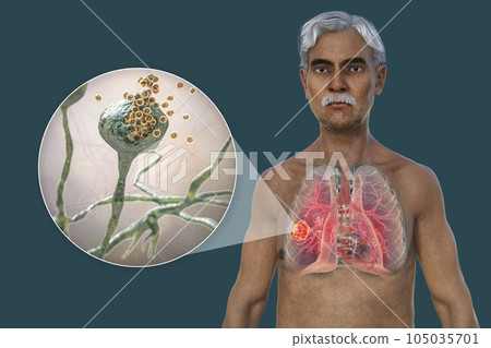 A 3D illustration of the upper half part of a man with transparent skin, revealing a lung mucormycosis lesion, with close-up view of Rhizopus fungi A 3D illustration of the upper half part of a man with transparent skin, revealing a lung mucormycosis lesion, with close-up view of Rhizopus fungi 105035701