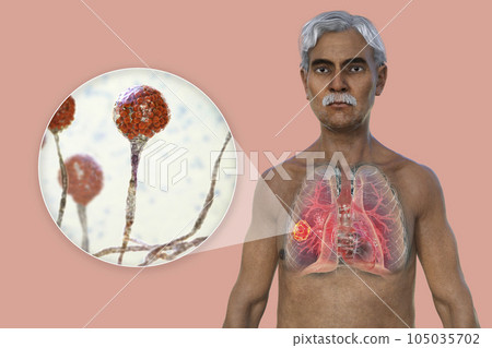 A 3D illustration of the upper half part of a man with transparent skin, revealing a lung mucormycosis lesion, with close-up view of Mucor fungi A 3D illustration of the upper half part of a man with transparent skin, revealing a lung mucormycosis lesion, with close-up view of Mucor fungi 105035702