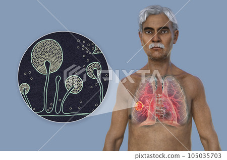 A 3D illustration of the upper half part of a man with transparent skin, revealing a lung mucormycosis lesion, with close-up view of Mucor fungi A 3D illustration of the upper half part of a man with transparent skin, revealing a lung mucormycosis lesion, with close-up view of Mucor fungi 105035703