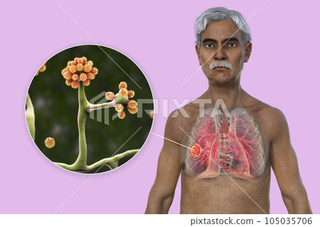A 3D illustration of the upper half part of a man with transparent skin, revealing a lung mucormycosis lesion, with close-up view of Cunninghamella bertholletiae fungi A 3D illustration of the upper half part of a man with transparent skin, revealing a lung mucormycosis lesion, with close-up view of Cunninghamella bertholletiae fungi 105035706