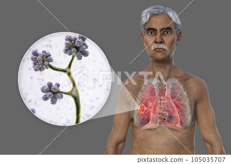 A 3D illustration of the upper half part of a man with transparent skin, revealing a lung mucormycosis lesion, with close-up view of Cunninghamella bertholletiae fungi A 3D illustration of the upper half part of a man with transparent skin, revealing a lung mucormycosis lesion, with close-up view of Cunninghamella bertholletiae fungi 105035707