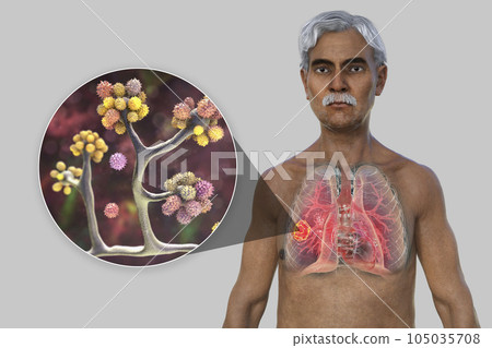 A 3D illustration of the upper half part of a man with transparent skin, revealing a lung mucormycosis lesion, with close-up view of Cunninghamella bertholletiae fungi A 3D illustration of the upper half part of a man with transparent skin, revealing a lung mucormycosis lesion, with close-up view of Cunninghamella bertholletiae fungi 105035708