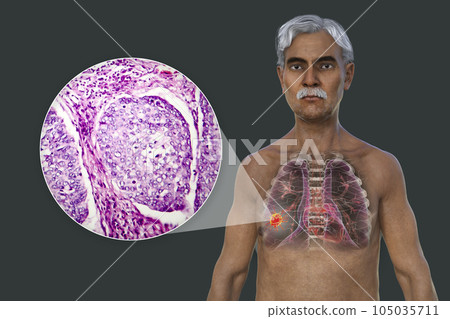 A 3D illustration of the upper half part of a man with transparent skin, revealing the presence of lung cancer A 3D illustration of the upper half part of a man with transparent skin, revealing the presence of lung cancer 105035711