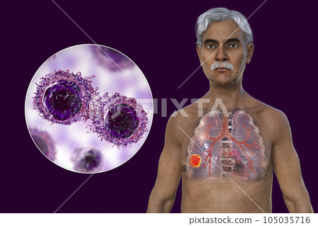 A 3D illustration of the upper half part of a man with transparent skin, revealing the presence of lung cancer A 3D illustration of the upper half part of a man with transparent skin, revealing the presence of lung cancer 105035716