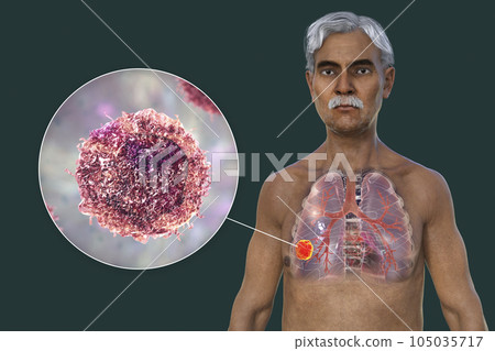 A 3D illustration of the upper half part of a man with transparent skin, revealing the presence of lung cancer A 3D illustration of the upper half part of a man with transparent skin, revealing the presence of lung cancer 105035717
