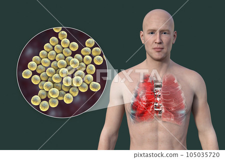 A 3D illustration showcasing the upper half part of a man with transparent skin, revealing the lungs affected by pneumonia A 3D illustration showcasing the upper half part of a man with transparent skin, revealing the lungs affected by pneumonia 105035720