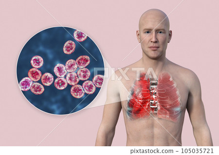 A 3D illustration showcasing the upper half part of a man with transparent skin, revealing the lungs affected by pneumonia 105035721