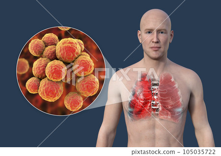 A 3D illustration showcasing the upper half part of a man with transparent skin, revealing the lungs affected by pneumonia 105035722